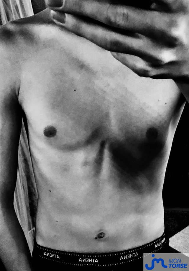 torses de Vincent du 78